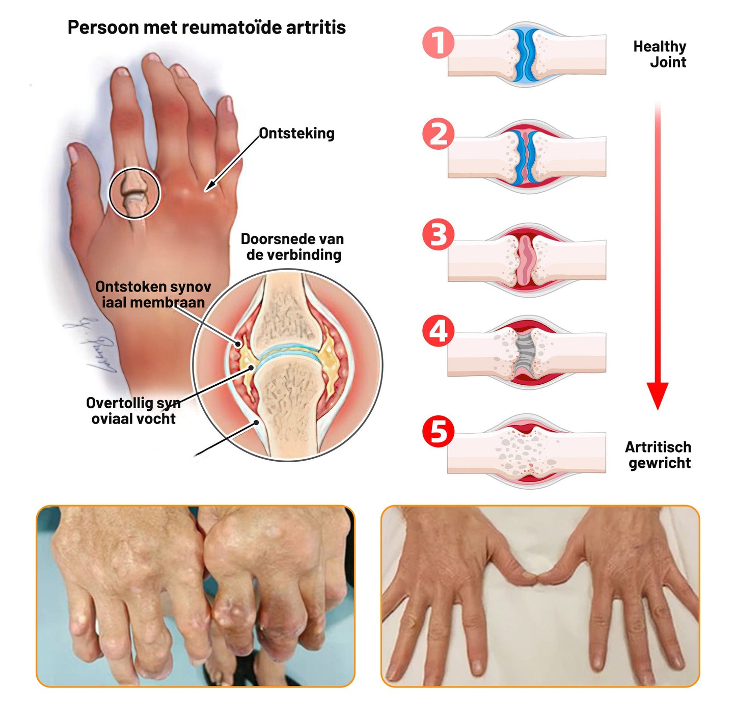 𝗧𝗟𝗢𝗣𝗔® Botox en Bijengif Pijnstillende Botherstellende Crème 丨💎 Nederlandse Orthopaedische Vereniging (NOV)💎(👨⚕️Aanbevolen door artsen: Geschikt voor mensen met gewrichtspijn, Puur natuurlijk extract, Gemakkelijk opneembaar, Pijnverlichtend)🌱
