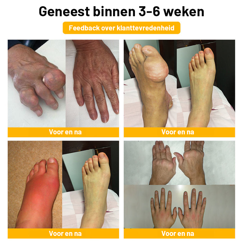 𝗧𝗟𝗢𝗣𝗔® Botox en Bijengif Pijnstillende Botherstellende Crème 丨💎 Nederlandse Orthopaedische Vereniging (NOV)💎(👨‍⚕️Aanbevolen door artsen: Geschikt voor mensen met gewrichtspijn, Puur natuurlijk extract, Gemakkelijk opneembaar, Pijnverlichtend)🌱
